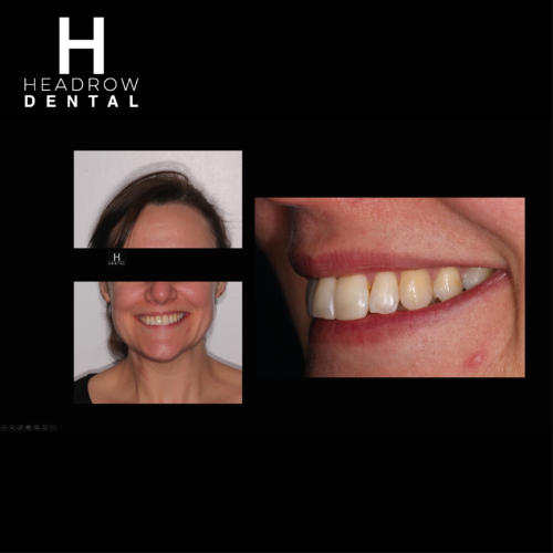 Headrow Dental Web images _ortho cases 3